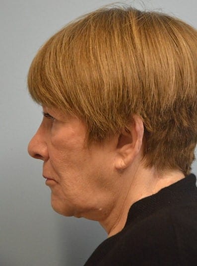 After Image: Brow Lift - left-side