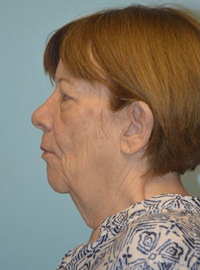 Before Image: Brow Lift - left-side