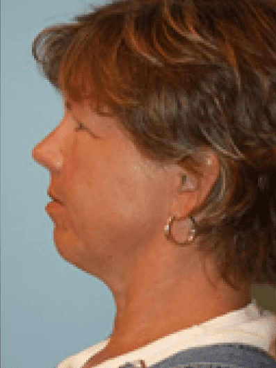 Before Image: Brow Lift - left-side