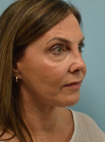 After Image: Facelift - right-front-oblique